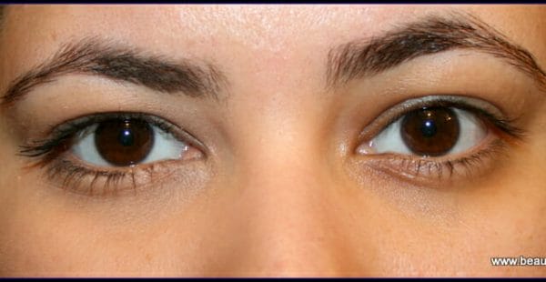 left eye - applied corrector : Right eye - nothing left eye - applied corrector : Right eye - nothing
